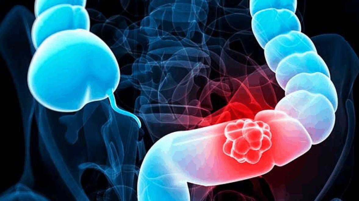 4 fruits that reduce the risk of colon cancer - Egypt Lelegraph